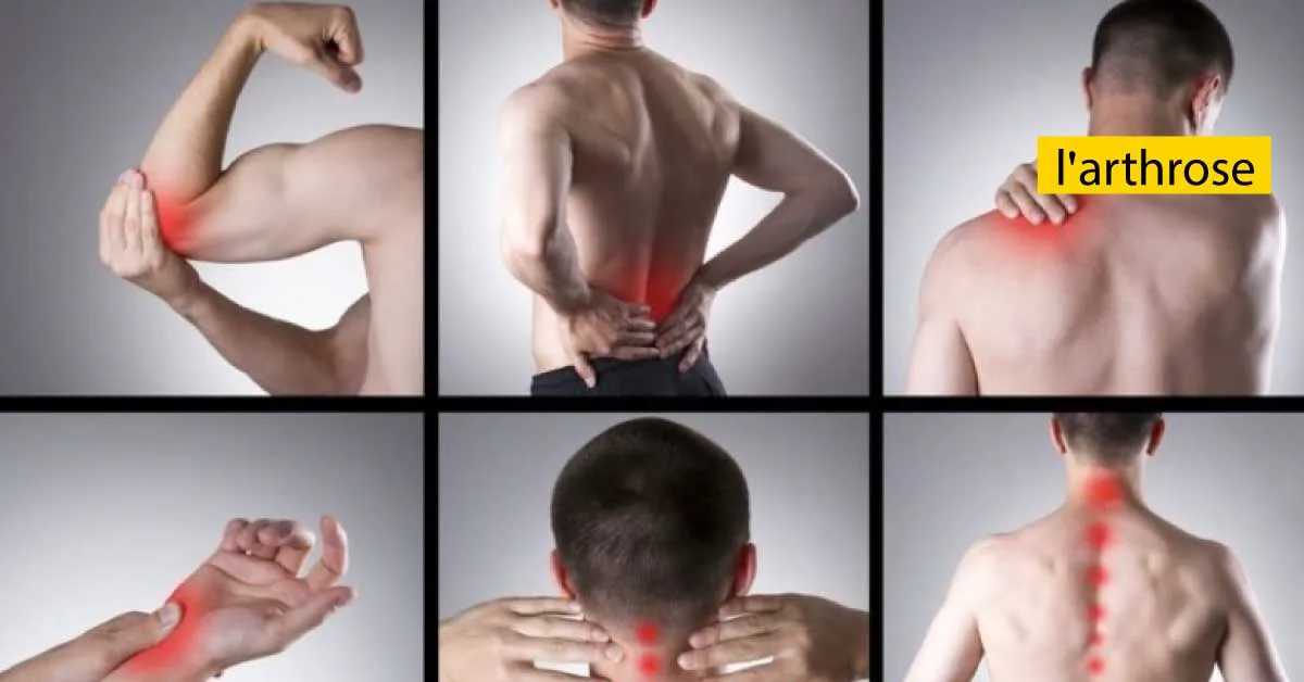 C'est Quoi L’arthrose